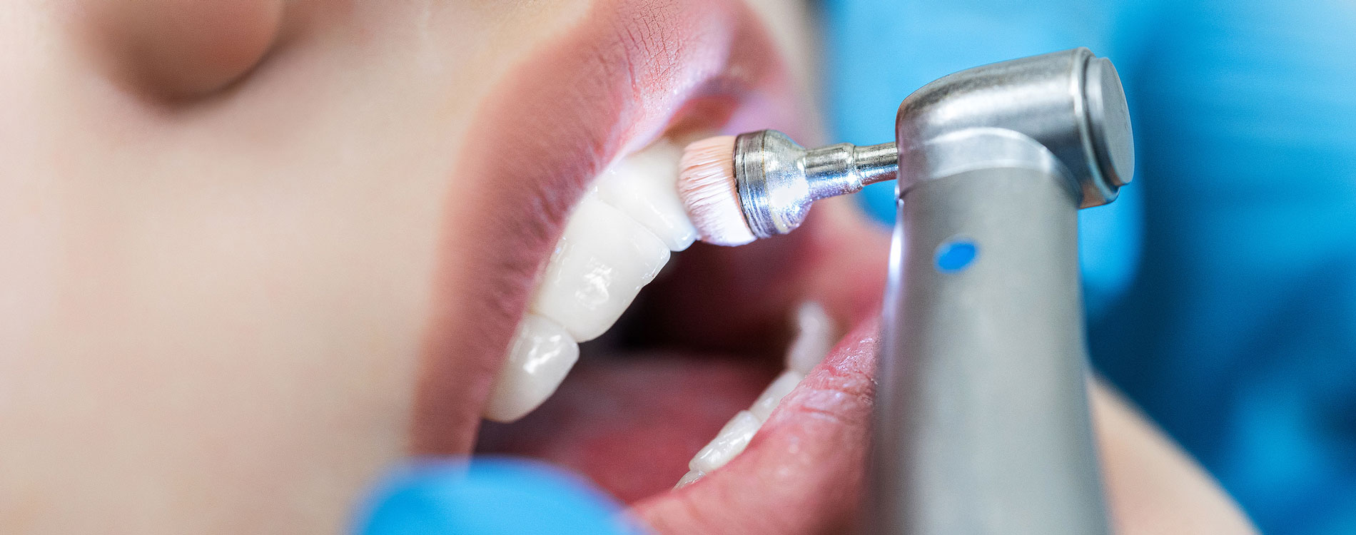 Professionelle Zahnreinigung (PZR) · Praxis für Kieferorthopädie · Dr. Sabine Ernst-Strauf