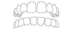 Lücken zwischen den Zähnen · Praxis für Kieferorthopädie · Dr. Sabine Ernst-Strauf